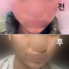 대기도 많이 길지 않았고 꼼꼼하게 시술 해주셨어요~