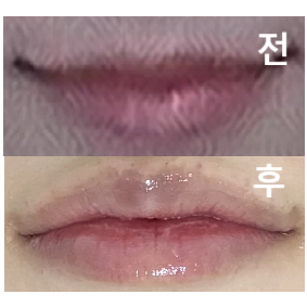 스텝분들 의사쌤 모두 다 친절하시고 상담이나 시술 엄청 꼼꼼히 해주세요!!