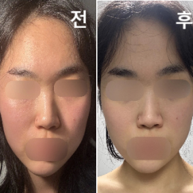 요즘 많이 먹었는데 갸름한거 보면 효과가 나름 있는 듯!