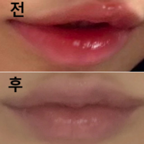 입술볼륨이랑 입꼬리 올라가고 싶어서 알아보다가 후기 좋아서 바로 예약하게 되었는데 진짜 완전 만족해요!!