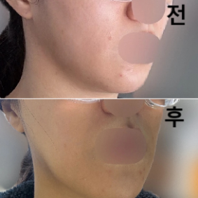 침샘보톡스보다는 턱보톡스가 효과가 빨리 나타나는 거 같아요~