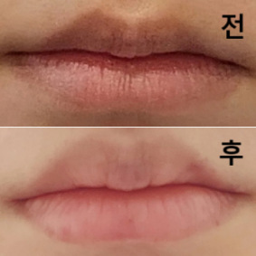 첫 입술필러라 고민 끝에 받아봤는데 만족해요~~!!