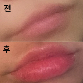 눈 코 광대 이마 고쳤는데요 입술 칭찬 제일 많이 들어요~!!