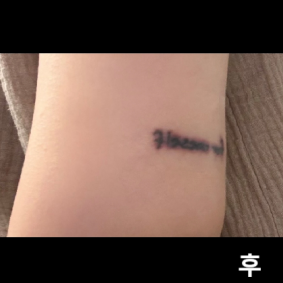 문신제거 1회차 받고 왔어요~ 빨리 지워졌으면 좋겠습니당~