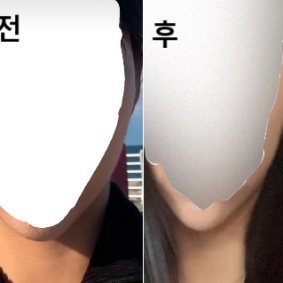 의사선생님께 원하는 부위 말씀드리니 최대한 반영해서 잘 해주셨어요!