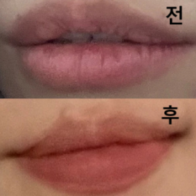 의사선생님 친절~~~ 멍도 안듦~~ 좋음~~