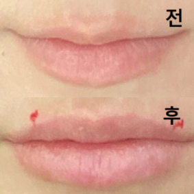 의사선생님이 정말 친절하셨고 제가 원하는 모양에대해 자세히 상담 해 주셨어요!