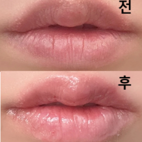 입술 비대칭 때문에 시술 받았는데요! 한 번 더 리터칭 받으면 좋아질 것 같아요~~ 넘 만족합니당~