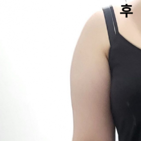 얼굴에 비해 팔, 부유방쪽은 좀 더 아프긴 했어요ㅠ 근데 붓기는 팔이 훨씬 잘 빠져요!
