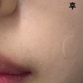 팔자 맞았는데 마취크림 + 마취주사하고 바로 쥬베룩 볼륨 시술! 완전 일사천리에요ㅋㅋ