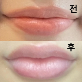 롤리팝 성형외과에서 입꼬리 필러 맞았는데 가격도 동일하고 친절하셨어요!!
