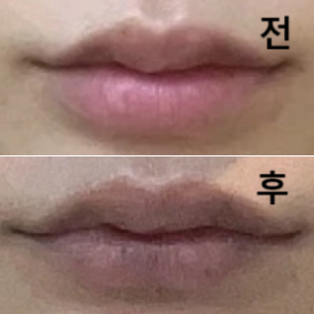다음날부터 붓기도 없어지고 필러도 완전히 녹아 감동이었습니다!