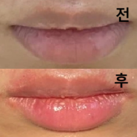 시술도 정성스러웠고 귀여운 입술이 되어 만족합니다!