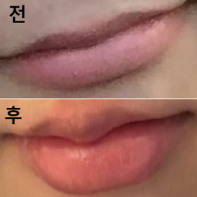 비용이 합리적이고 시술할 때 따끔거리는 거 말고는 이후 아프지 않았어요!