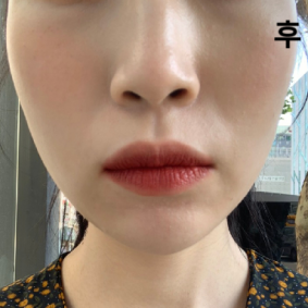 시술 잘 받고 대기없이 빠르게 받았어요~~~