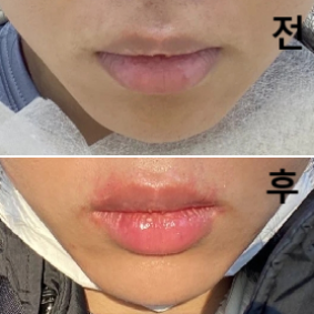 쥬비덤 1CC랑 엘라보톡스 했어요! 선생님 상냥하시고 말걸기도 해주셔서 마음이 놓였고 또 이용하고 싶습니다!