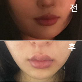 아직 더 지켜봐야겠지만 확실히 효과가 좋은 것 같아요!!