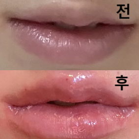 시술 중간에 계속 거울 보여주시면서 원하는 모양 만들어주셨어용 최공!