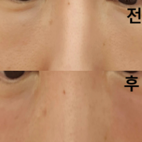 애교 밑 필러퍼짐 때문에 방문했어요~ 주사자국 없고 멍 없어 만족합니다!