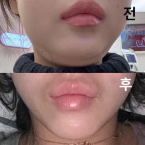 제가 인모드는 정말 아파서 못 받는데 이건 덜 아프고 효과가 너무 좋아서 꾸준히 맞습니다! 추천해여!!