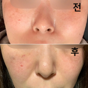 피부고민이나 피부 상태에 맞게 조언을 해 주시고 수술 후 컨디션 불량 없는지 확인해주셔서 매우 안심하고 시술 받았어요~