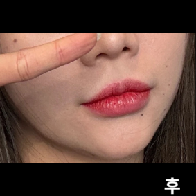 전에도 시술 받고 너무 만족스러워서 다시 재방문 하고 친구들한테도 추천 했어여!!