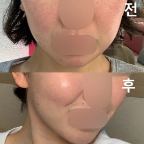 꾸준히 맞고 있는데 효과 있어요 ㅎㅎㅎ 유목민인데 대용량에 저렴해서 다른 병원 안 가고 여기 정착했습니당~