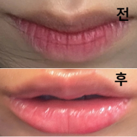 필러 맞을 때 중간중간 몰딩 엄청 섬세하게 해주세여! 필러 빠지면 또 가려구요 ♥