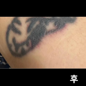 얼음팩으로 마비 시키니까 저는 별로 안 아프게 시술 받았구 명함사이즈 꽉꽉 채운 진한 타투였습니다!