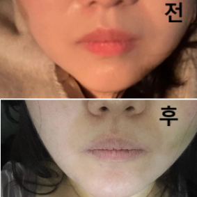 얼굴 지방이 많은 편이라 주기적으로 맞는 중인데 효과 있어요~ 투 턱 라인정리가 싹 돼서 너무 좋아용~