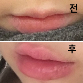 시술 할 때 제가 거울로 계속 보면서 넣을 수 있어서 자기 만족도가 높았어요!!