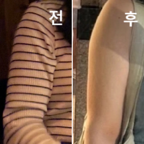 팔이 잘 안빠지던 부분인데 꾸준히 맞으니 빠지면서 정돈 되는게 느껴지네요~