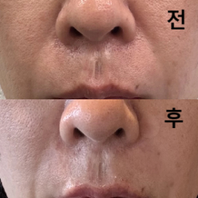 필러 그 자리에서 개봉하는 것 확인 시켜 주시고 시술도 거울로 확인하면서 해줘서 너무 만족스러워요~