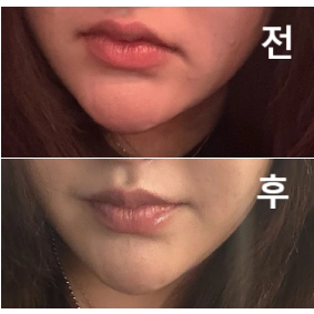 시술해주신 여자 원장님이 너무 친절하셔서 좋았습니당~