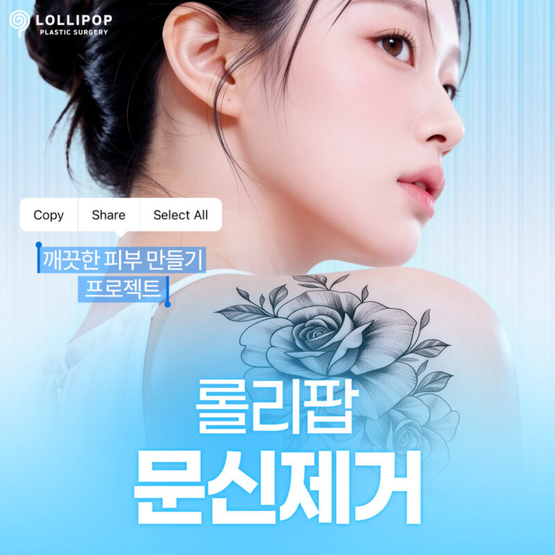 롤리팝 문신제거