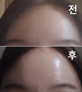 진짜 필러는 정원장님이 제일 잘 녹여주세요 진심입니다!