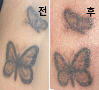 다른 병원과 마찬가지로 시술은 아픈 편이나 친절하고 사후 관리키트를 챙겨줘서 좋았어요!