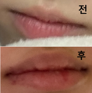 부담스럽지 않게 가로 길이 확장 목적으로 간 거라 가성비 대비 좋은 병원이라 생각합니다!!