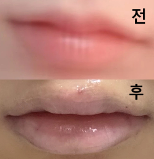 2일차인 지금 멍도 거의 없고 자연스러워요~ 2주 뒤 리터치 하러 갈거에여^^