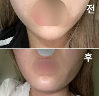 스테로이드 없는 걸로 맞았는데 저번보다 조금 더 아팠지만 참을만 한 정도였어용