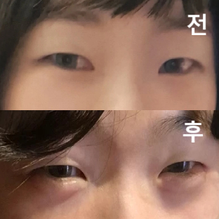 오랜만에 맞는거라 떨렸는데 잘 달래주셔서 멍 없이 예쁘게 잘 받았습니다! 모양이랑 볼륨감 다 맘에 들어요~~