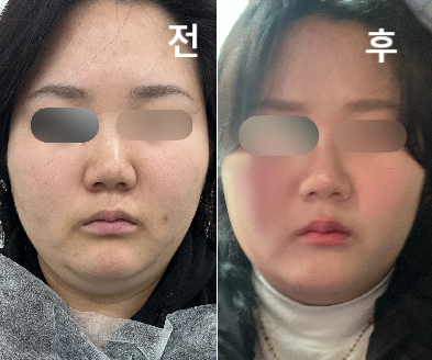 인모드 윤곽 같이 해서 그런가 효과 나쁘지 않았어요!!