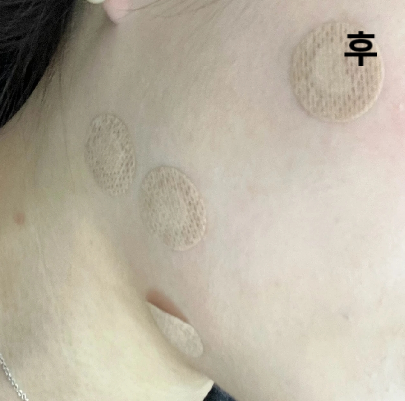 친구가 여기서 몇 회 맞고 효과 좋았대서 한 번 맞아봤고 두 세 번 더 맞아볼 생각이에요!