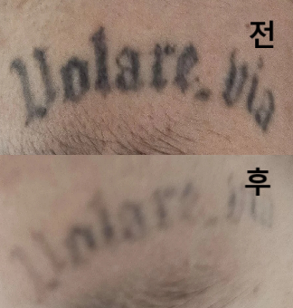 두 가지 레이저로 시술해주신다고 해서 받았어요~
