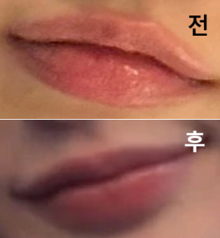 가격도 이벤트 그래도였고 별로 안 아프고 멍도 안 들어서 너무 만족합니다!!