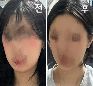 다른거 권유없이 제가 스트레스였던 부분만 콕 집어서 그 부분 시술 해주시겠다고 해서 좋았어용! 효과도 좋은 것 같아용!!
