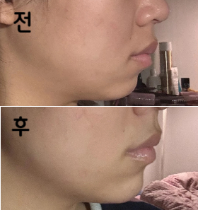 결과는 자연스럽게 잘 됐구 별로 안 아팠어요~!