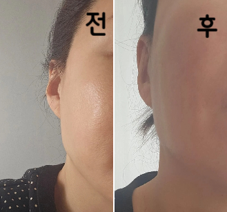 필요없는 필러 잘 녹았구요~~ 만족합니다~~