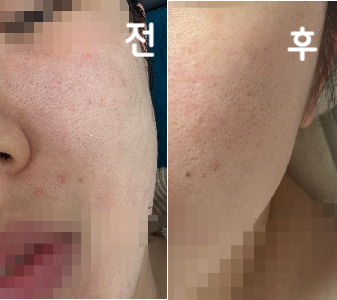 급하게 포텐자를 하려고 예약되는 병원이라 갔는데 잘 간 것 같아요 원장님이 엄청 친절하셨어요!