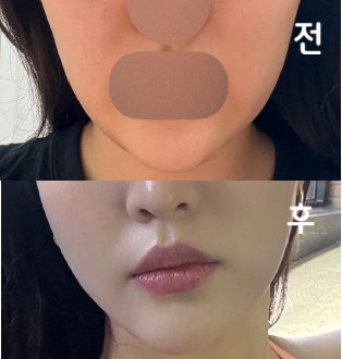 한 번 맞았는데도 고민부위가 많이 갸름해진게 느껴져서 꾸준히 맞아볼라구요~